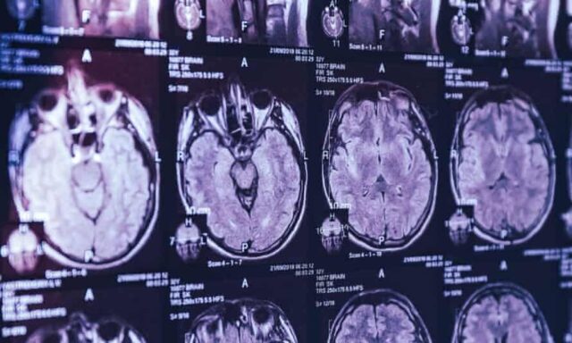Çrregullimi misterioz i trurit në 43 njerëz huton mjekët kanadezë