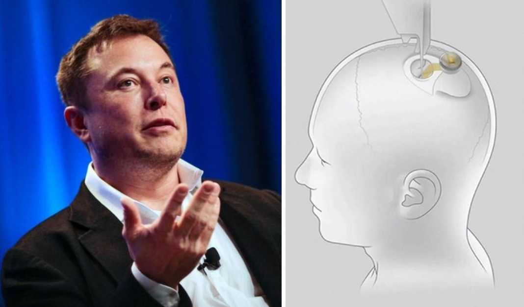 Elon Musk do të nisë transplantimin e çipeve në trurin e njeriut vitin e ardhshëm